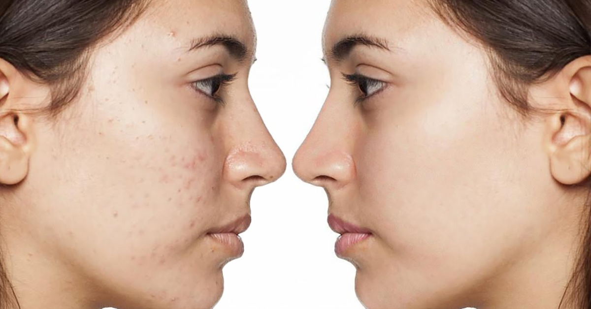 rukhma anti acne serum